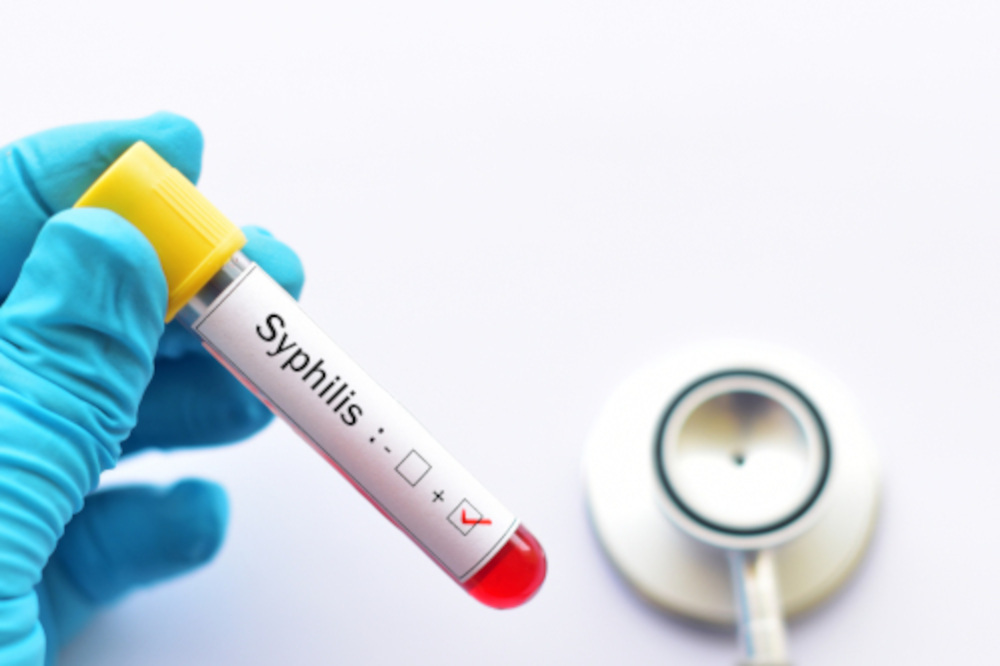 syphilis (kiła) – badania