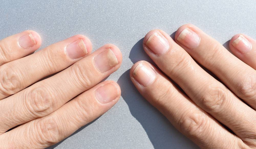 onycholiza paznokci u rąk