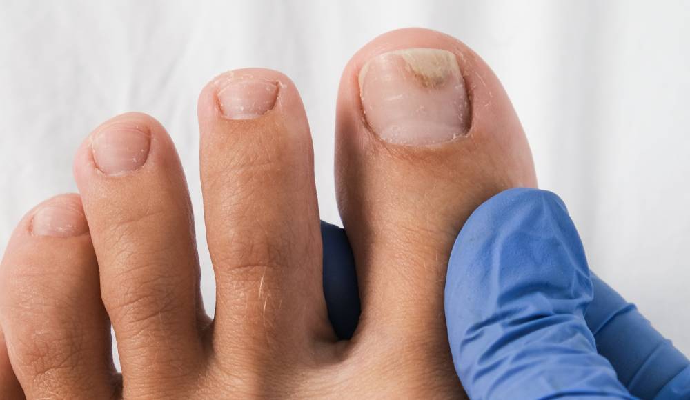 onycholiza paznokcia u stopy